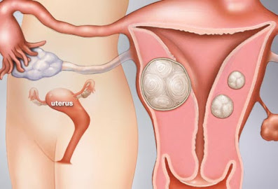 Stop%2Bletting%2Bthem%2Btake%2Byour%2Bmoney%252C%2Bno%2Bsupplements%2Bcan%2Bdissolve%2Bfibroids.jpg