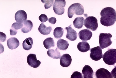 gonorrhea.jpg