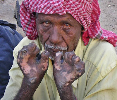 40%2Bpeople%2Bhit%2Bwith%2Bleprosy%2Bin%2BNasarawa%2Bin%2Bjust%2B2%2Bweeks.jpg