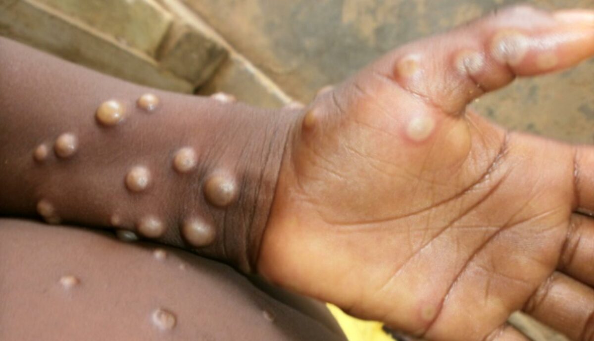 First monkeypox case confirmed in Kwara First Monkeypox Case Confirmed In Kwara State