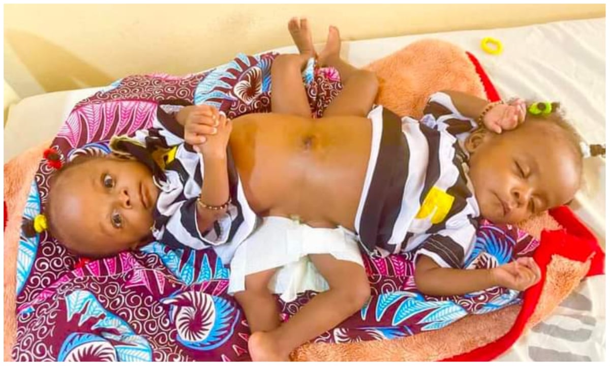 Dubai hospital to separate Nigerian conjoined twins for free Dubai hospital to separate Nigerian conjoined twins for free
