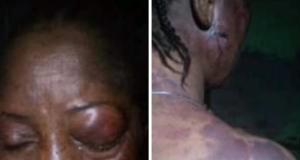 Mother-Of-five Battered By Husband Seeks Justice Mother-Of-five