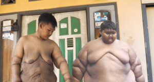 World’s Fattest Boy Undergoes Incredible Transformation And Is Now Unrecognisable World's Fattest Boy Undergoes Incredible Transformation