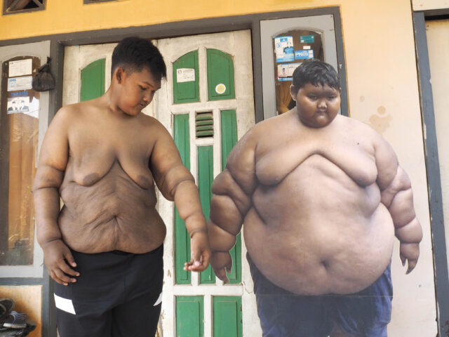 World's Fattest Boy Undergoes Incredible Transformation
