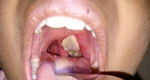 Diphtheria: 130 hospitalised in Kano Diphtheria