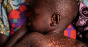 31 children killed in South Sudan’s Unity State measles outbreak South Sudan’s Unity State measles