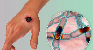 Nigeria confirms first Anthrax case Anthrax
