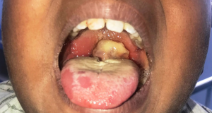 One dies of diphtheria in Osun diphtheria