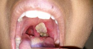 1,534 cases of diphtheria confirmed in Nigeria 1,534 cases of diphtheria confirmed in Nigeria