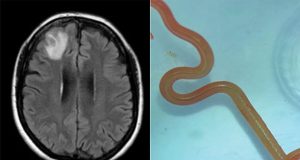 Live worm found in woman’s brain in world first Live worm found in woman's brain in world first