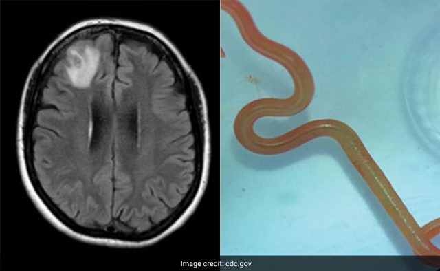 skbvn1so_the-live-roundworm-after-it-has-been-removed-from-the-patients-brain_625x300_29_August_23ladunliadisnews.com_ Live worm found in woman's brain in world first