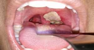 Diphtheria: WHO rates Nigeria as high risk with over 4,700 confirmed cases Diphtheria: WHO rates Nigeria as high risk with over 4,700 confirmed cases