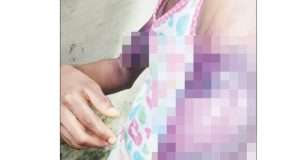 Landlord bathes 11-year-old girl with hot water Landlord bathes 11-year-old girl with hot water
