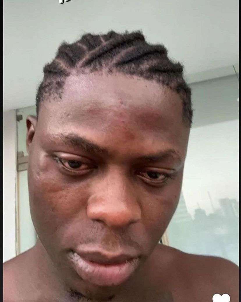 Heartbreaking photos of Mohbad with injuries on his face 