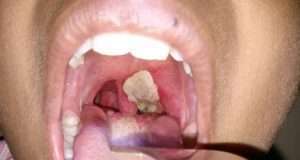 Diphtheria claims 453 lives in 18 states – FG Diphtheria claims 453 lives in 18 states – FG