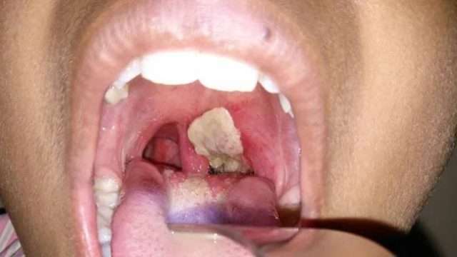 Diphtheria claims 453 lives in 18 states – FG