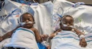 Conjoined twins DIE days after delivery in Lagos Conjoined twins DIE days after delivery in Lagos