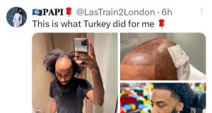 Bald man shows off amazing hair transplant surgery transformation Bald man shows off amazing hair transplant surgery transformation