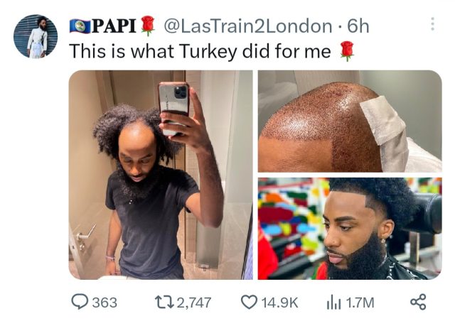 Bald man shows off amazing hair transplant surgery transformation 