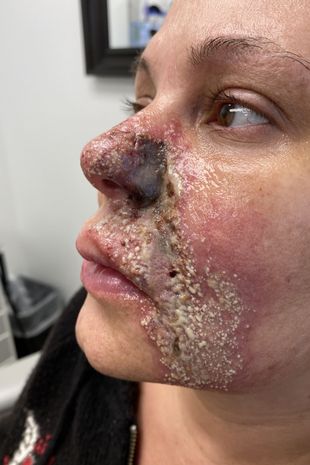 Woman left with 'rotted' nose after filler injection 