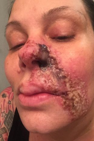 Woman left with 'rotted' nose after filler injection 