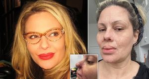 Woman left with ‘rotted’ nose after filler injection Woman left with 'rotted' nose after filler injection