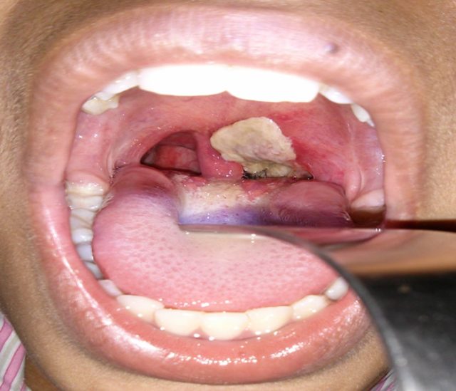 Diphtheria kills four children in Nasarawa