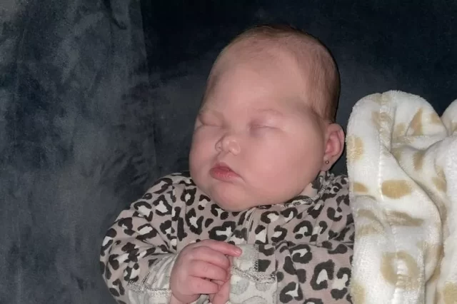 baby was born without eyes and had half her brain removed