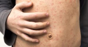 UK declares 'national incident' over measles outbreak