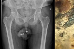 Three batteries get stuck in man's p3nis after he shoved them in there for pleasure