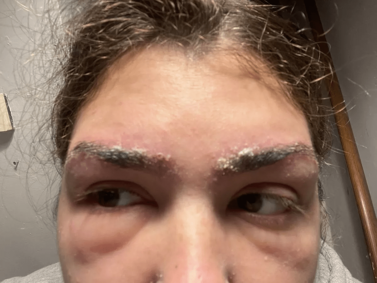Woman left 'one-eyed' after brow tint 2 Woman left 'one-eyed' after brow tint