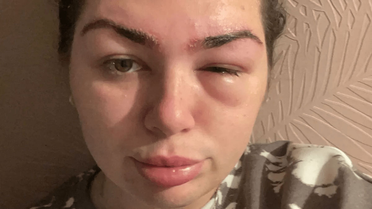 Woman left 'one-eyed' after brow tint