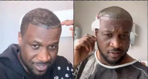 Peter Okoye undergoes hair transplant because of baldness Peter Okoye of P-square undergoes hair transplant in Turkey