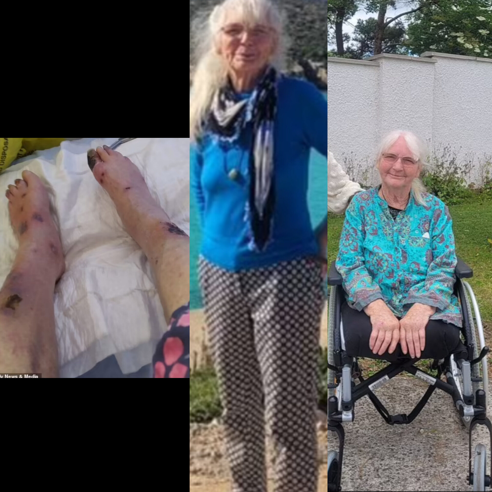 Grandma's legs amputated after 'mosquito' bite Grandma's legs amputated after 'mosquito' bite