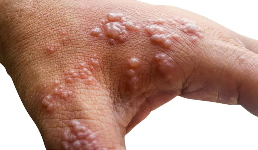 Nigeria records 39 mpox cases mpox