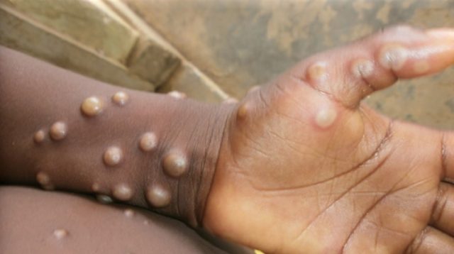 China reports five cases of new Mpox strain China reports five cases of new Mpox strain