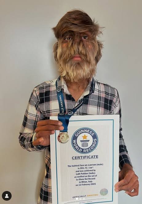 Teen sets record for hairiest face in the world