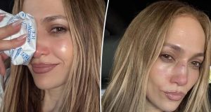 Jennifer Lopez suffers nasty face injury Jennifer Lopez suffers nasty face injury