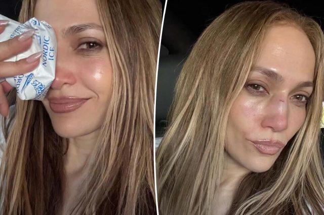 Jennifer Lopez suffers nasty face injury Jennifer Lopez suffers nasty face injury