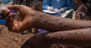 Gambia declares mpox outbreak Gambia declares mpox outbreak