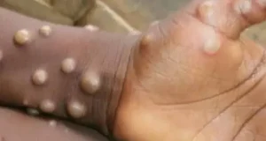 Ghana records first Mpox de.ath Ghana records first Mpox de.ath