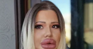 Woman with ‘world’s biggest lips’ in severe pain BUT Docs won’t touch her