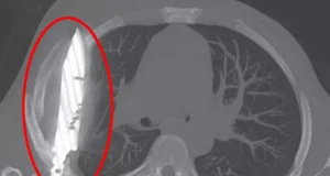 Doctors find large knife lodged in man’s chest for EIGHT years Stunned doctors found a man had been living with a large knife blade lodged in his chest for eight years