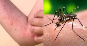 NCDC warns of chikungunya outbreak NCDC warns of chikungunya outbreak