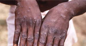 Ondo confirms 12 cases of M-pox Ondo confirms 12 cases of M-pox