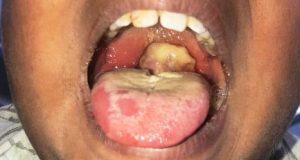 Diphtheria outbreak k!lls 10 children Diphtheria outbreak k!lls 10 children