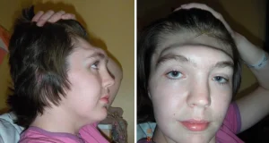 Woman who lost entire forehead in accident shares incredible transformation FOREHEAD