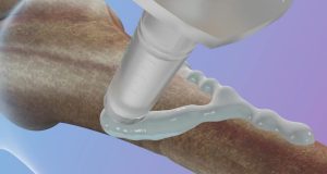 Chinese-made ‘bone glue’ fixes fractures in just 3 minutes Chinese-made ‘bone glue’ fixes fractures in just 3 minutes