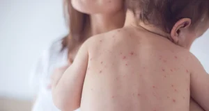 Measles de.ath toll hits 153 in 11 months Measles de.ath toll hits 153 in 11 months