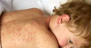 Measles outbreak spreads through UK Measles outbreak spreads through UK